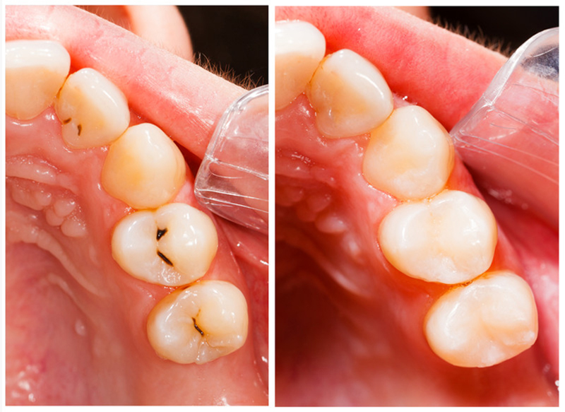 Fillings MI