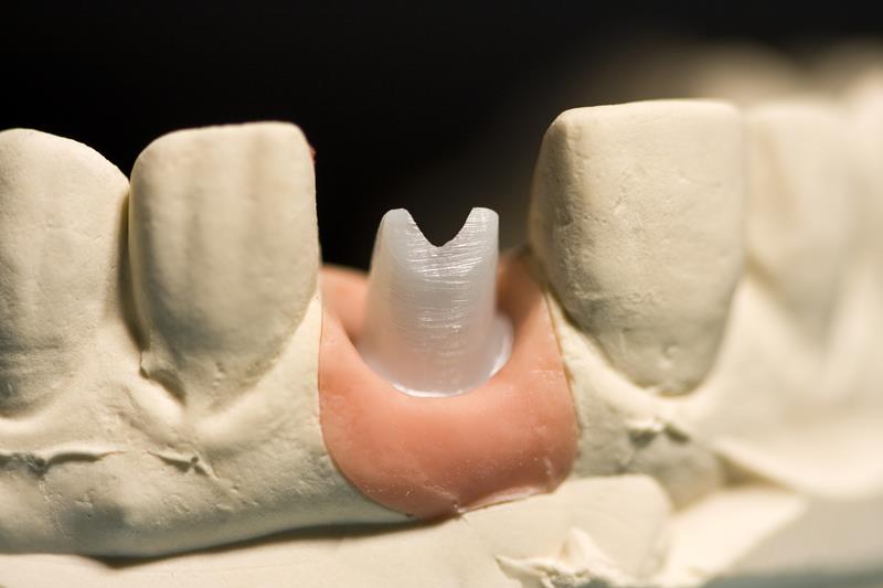 Implant Restoration MI