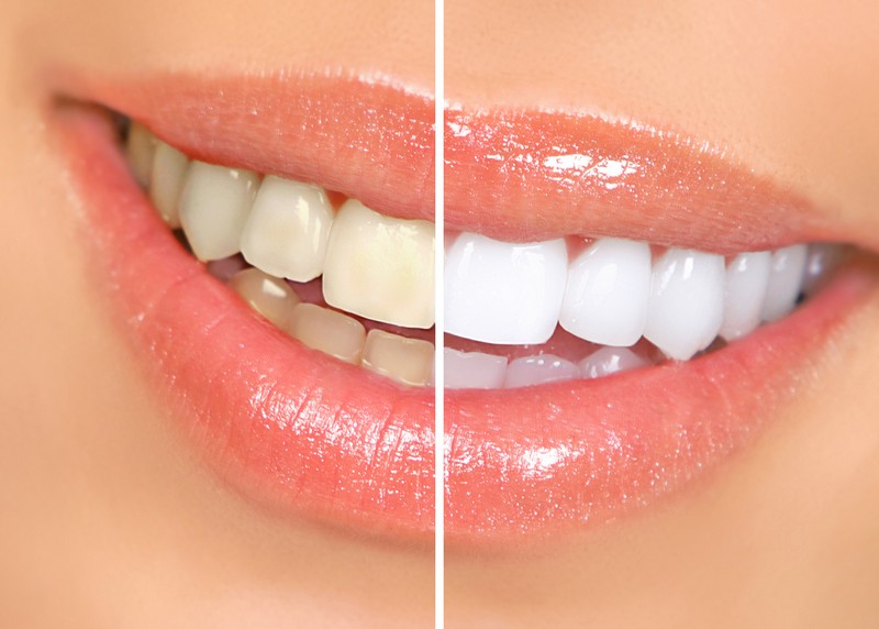 Teeth Whitening MI