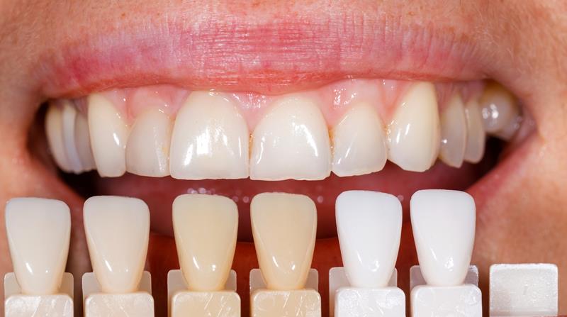 Veneers MI